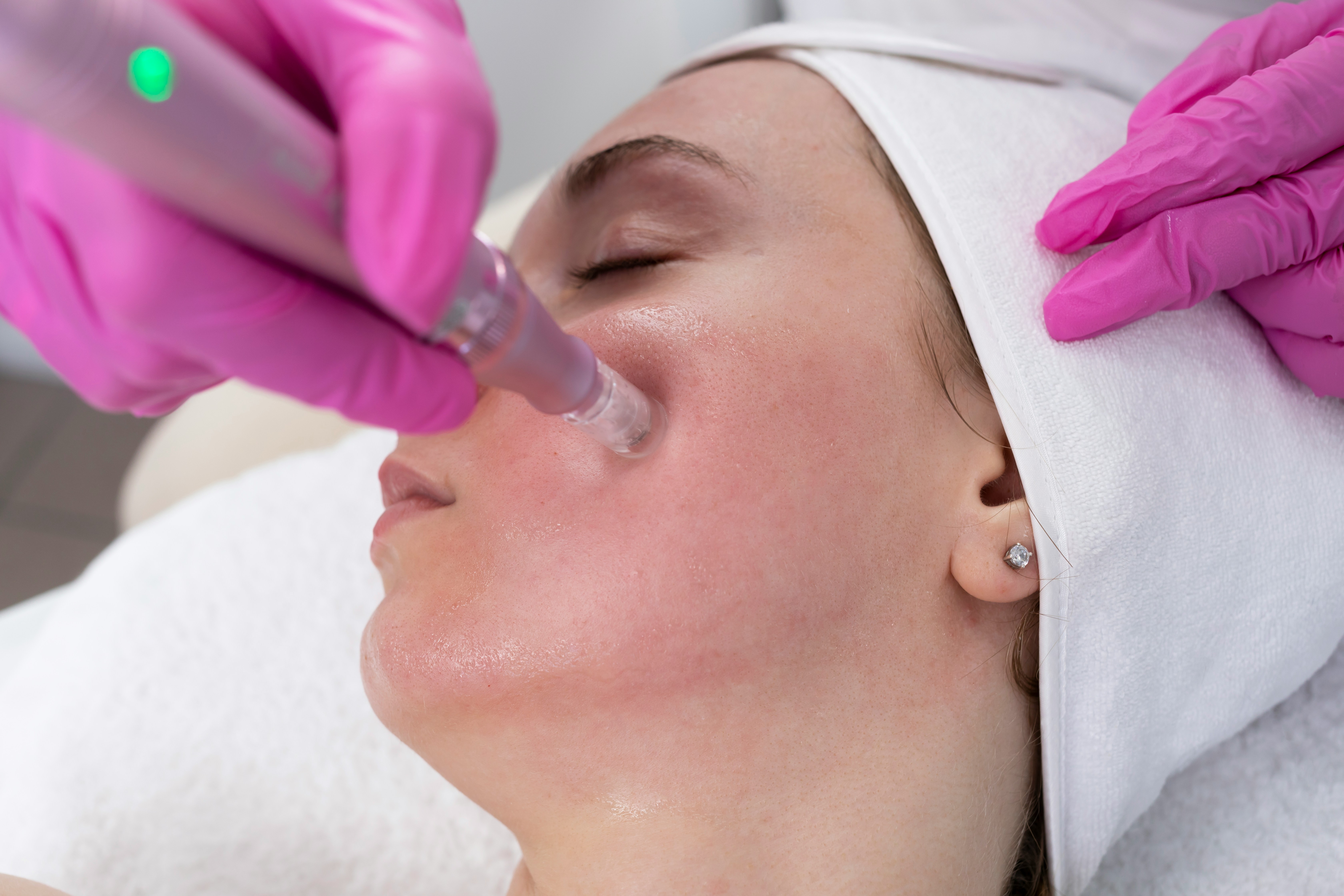 Microneedling women