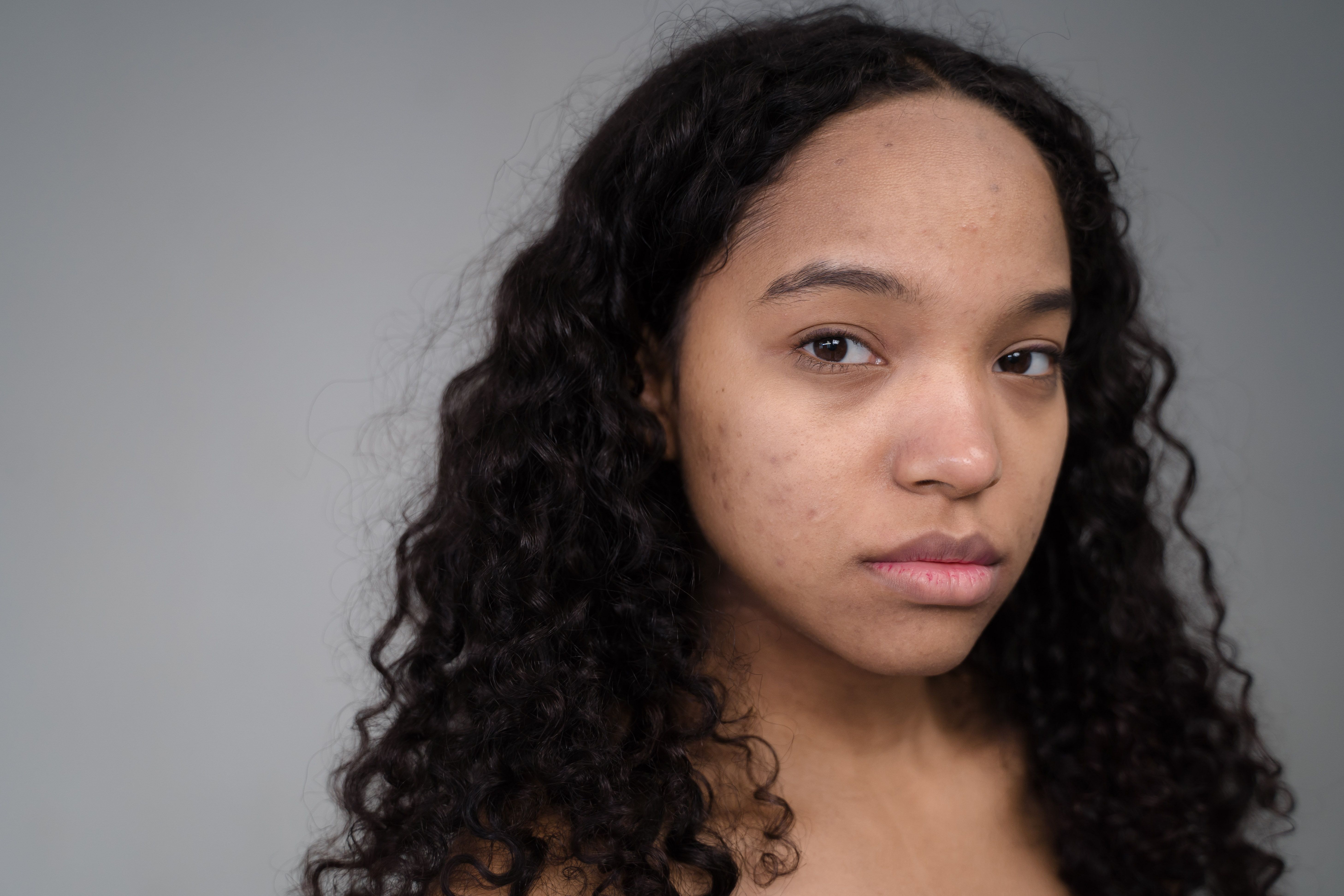 Close-up of skin texture from acne scarring before makeup application
