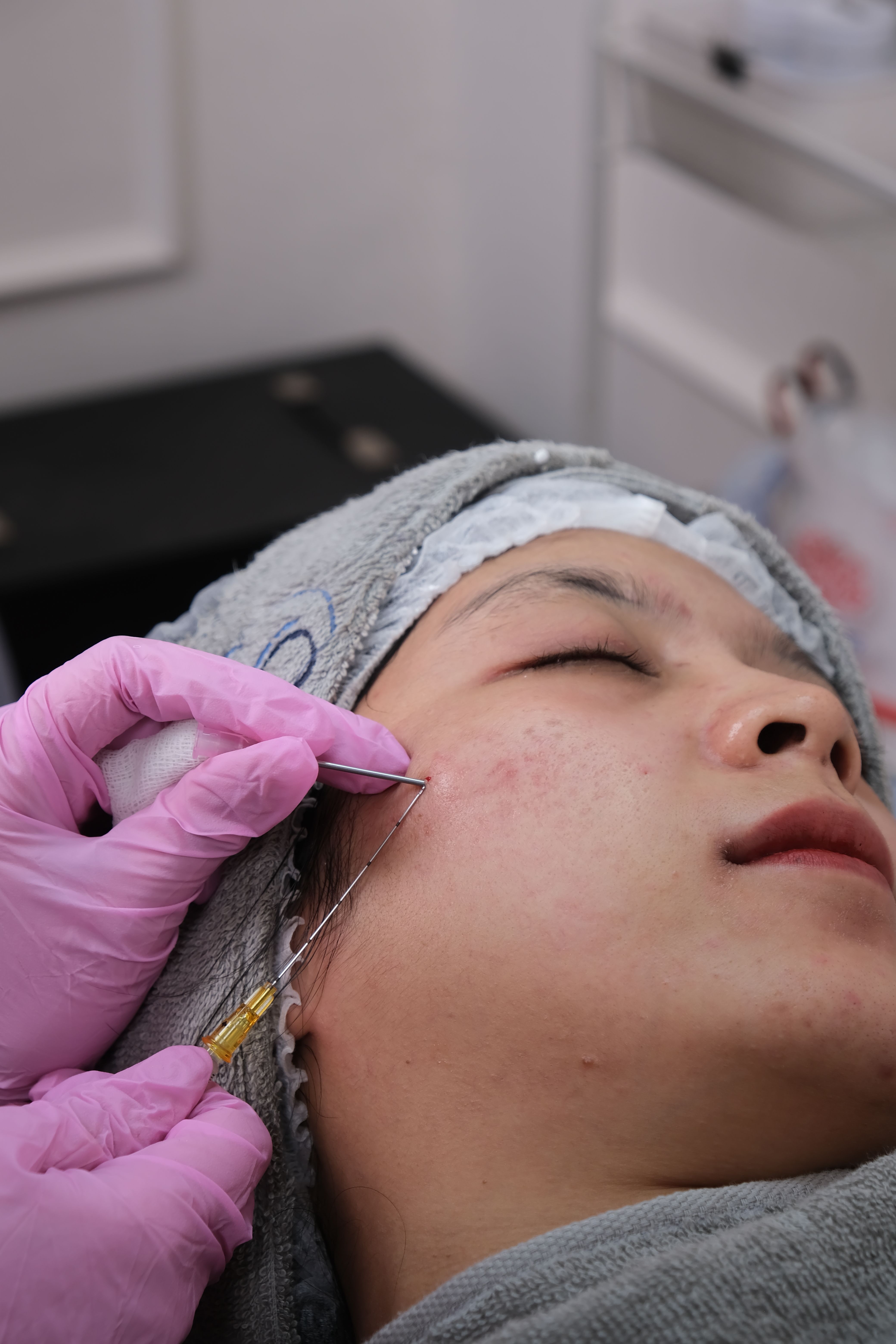 Close-up of skin during a microneedling treatment for acne scarring